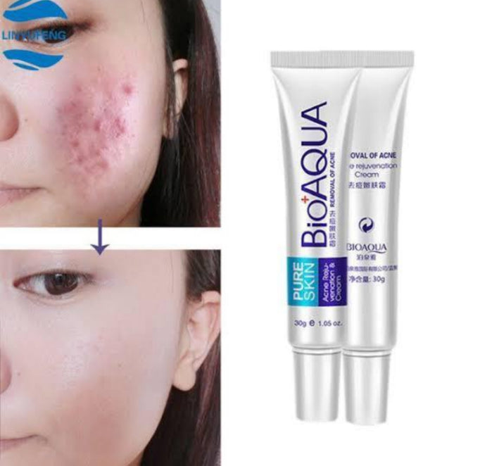 Acne Removal Cream 30g